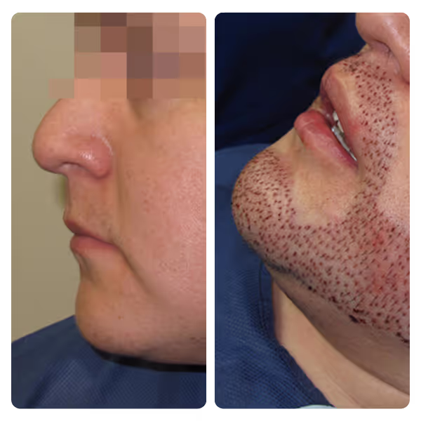 Moustache Transplant in Turkey